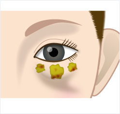 すぐに眼窩脂肪が出てきますので、突出していた部分の脂肪を目頭側、中央、目尻側とバランスよく切除します。