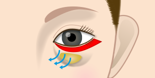 ハムラ法のポイントは眼窩脂肪の移動
