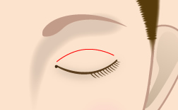 眼瞼挙筋前転法