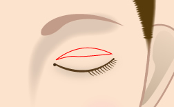 重瞼ライン切開法