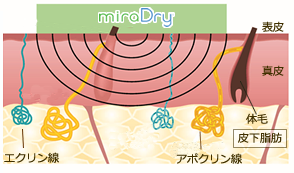 （1）マイクロ波により汗腺を選択的に破壊