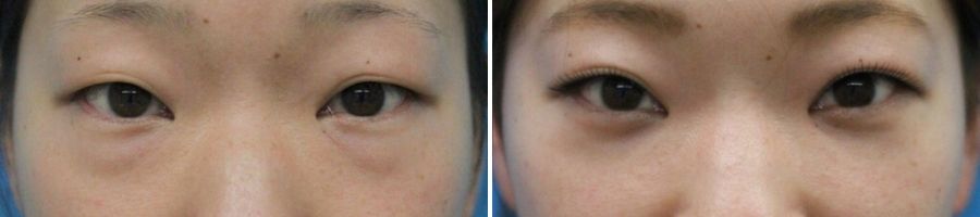 経結膜ハムラ法　症例