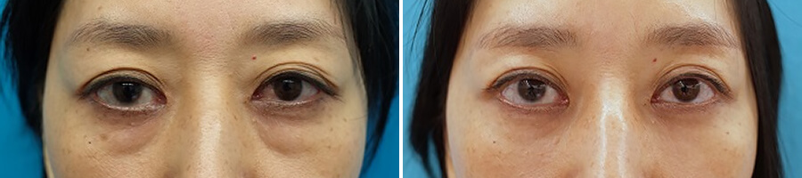 脱脂CRF法　症例