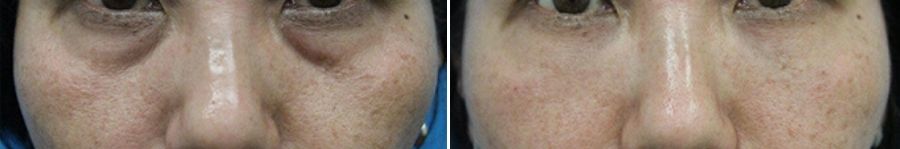 脱脂CRF法　症例