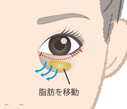 経結膜ハムラ法（裏ハムラ法）