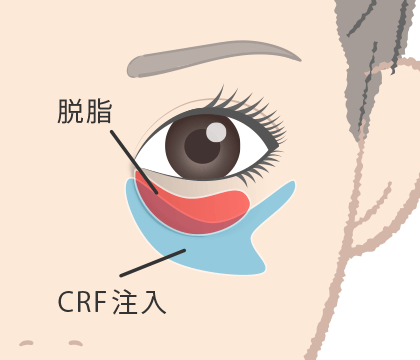 脱脂CRF法