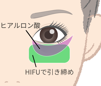 切らない治療法