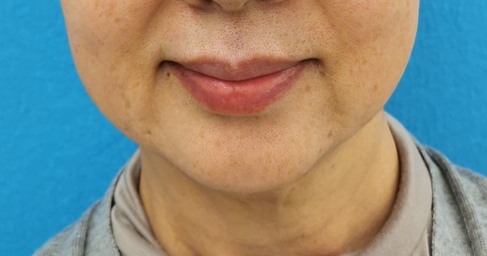 ボルベラ（唇）のヒアルロン酸注入の症例 AFTER
