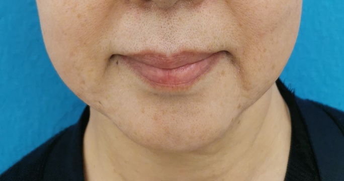 ボルベラ（唇）のヒアルロン酸注入の症例 BEFORE