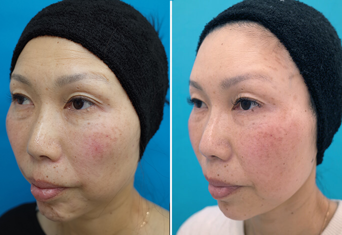 ヒアルロン酸注入　症例