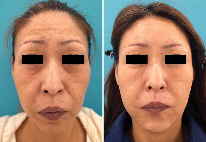 ヒアルロン酸注入　症例