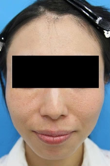 名古屋 大阪梅田で顔のこけ治療 エースクリニック しわ たるみ治療 美容外科 美容皮膚科