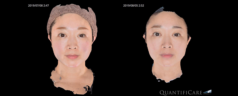 Bnls大量注射 第2弾 名古屋の美容外科 美容皮膚科 エースクリニック
