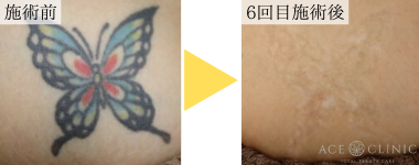 タトゥー除去はqスイッチレーザーからピコレーザーの時代へ 名古屋の美容外科 美容皮膚科 エースクリニック