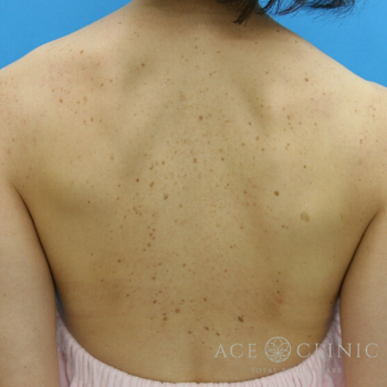 シミ ピコレーザー 背中の老人性色素斑の治療 症例紹介 名古屋駅すぐ 美容外科 美容整形のエースクリニック