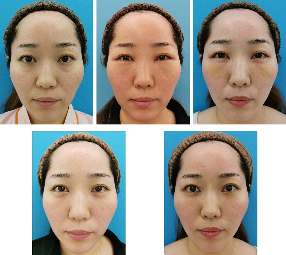目の下のクマ手術 経結膜ハムラ法 30代女性の症例 鼻とほうれい線のヒアルロン酸注射同時 名古屋の美容外科 美容皮膚科 エースクリニック