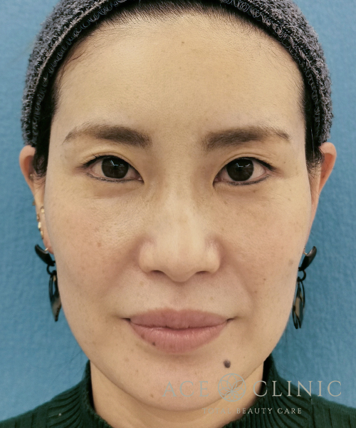 名古屋 大阪梅田で脂肪注入 Crf エースクリニック しわたるみ治療 美容外科 美容皮膚科