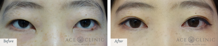 蒙古襞 もうこひだ の方にオススメな目頭切開術 名古屋の美容外科 美容皮膚科 エースクリニック