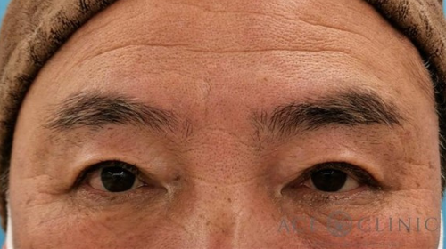 上まぶたのたるみ取り 眉毛下切開法 実は男性にもおすすめの施術です 名古屋の美容外科 美容皮膚科 エースクリニック