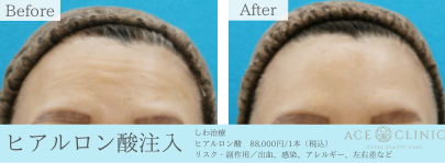名古屋 大阪梅田でしわ治療 エースクリニック しわ たるみ治療 美容外科 美容皮膚科