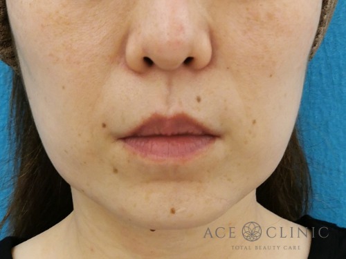 症例紹介一覧 エースクリニック 名古屋 大阪梅田 美容外科 美容整形 名古屋の