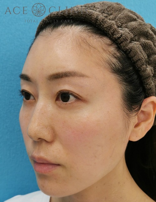 ヒアルロン酸注入 エースクリニック 名古屋院