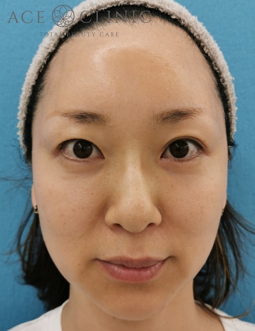 ヒアルロン酸注入 エースクリニック 名古屋院