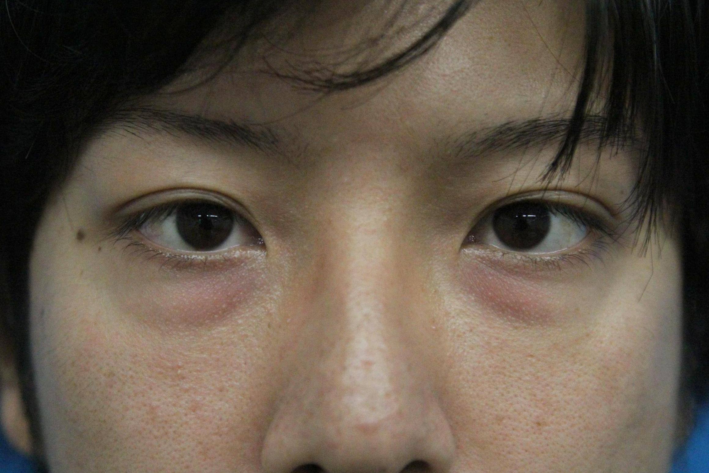 目の下のクマ手術 経結膜ハムラ法 男性 名古屋の美容外科 美容皮膚科 エースクリニック