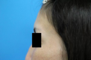 マイクロCRF　額・コメカミ　治療前　左横からの写真