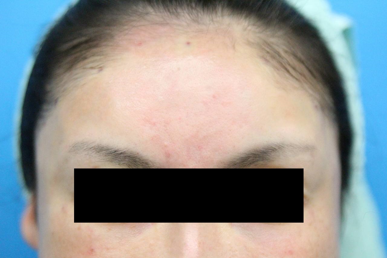 マイクロcrf 額 こめかみの症例 名古屋の美容外科 美容皮膚科 エースクリニック