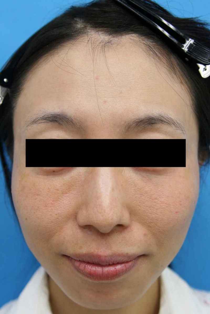 セルリバイブジータ モニター症例 名古屋の美容外科 美容皮膚科 エースクリニック