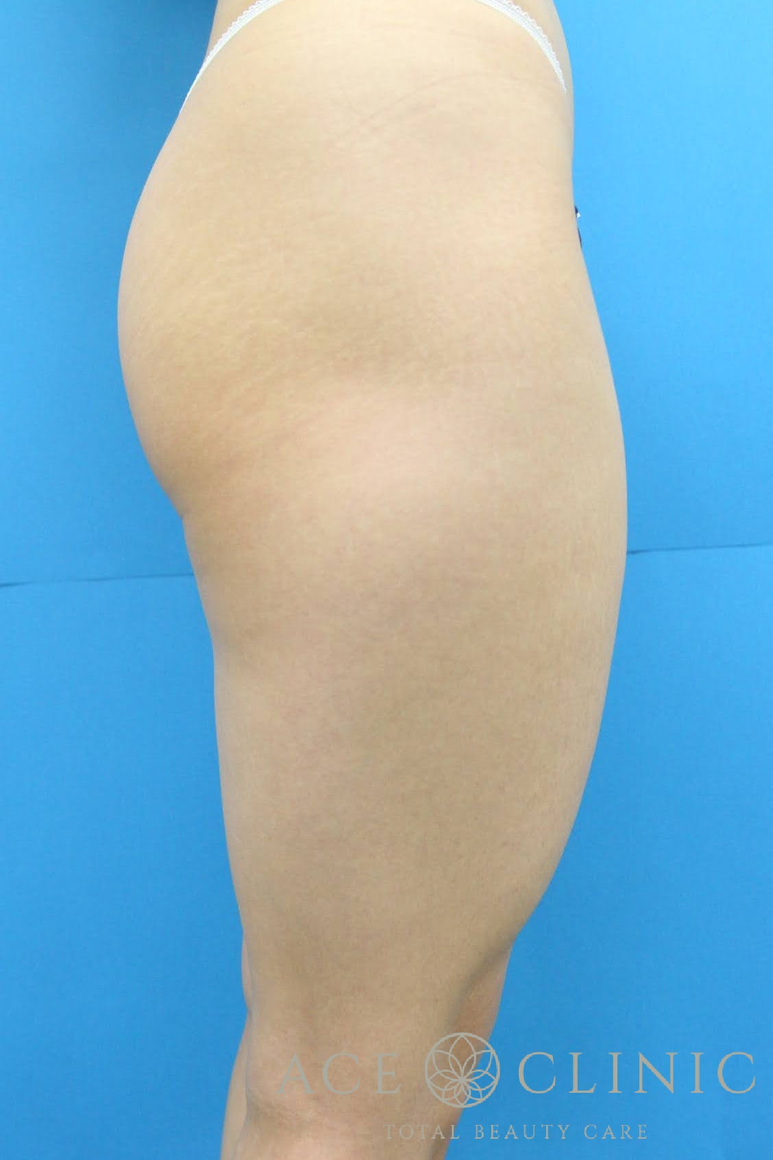 大腿脂肪吸引　右横　術前
