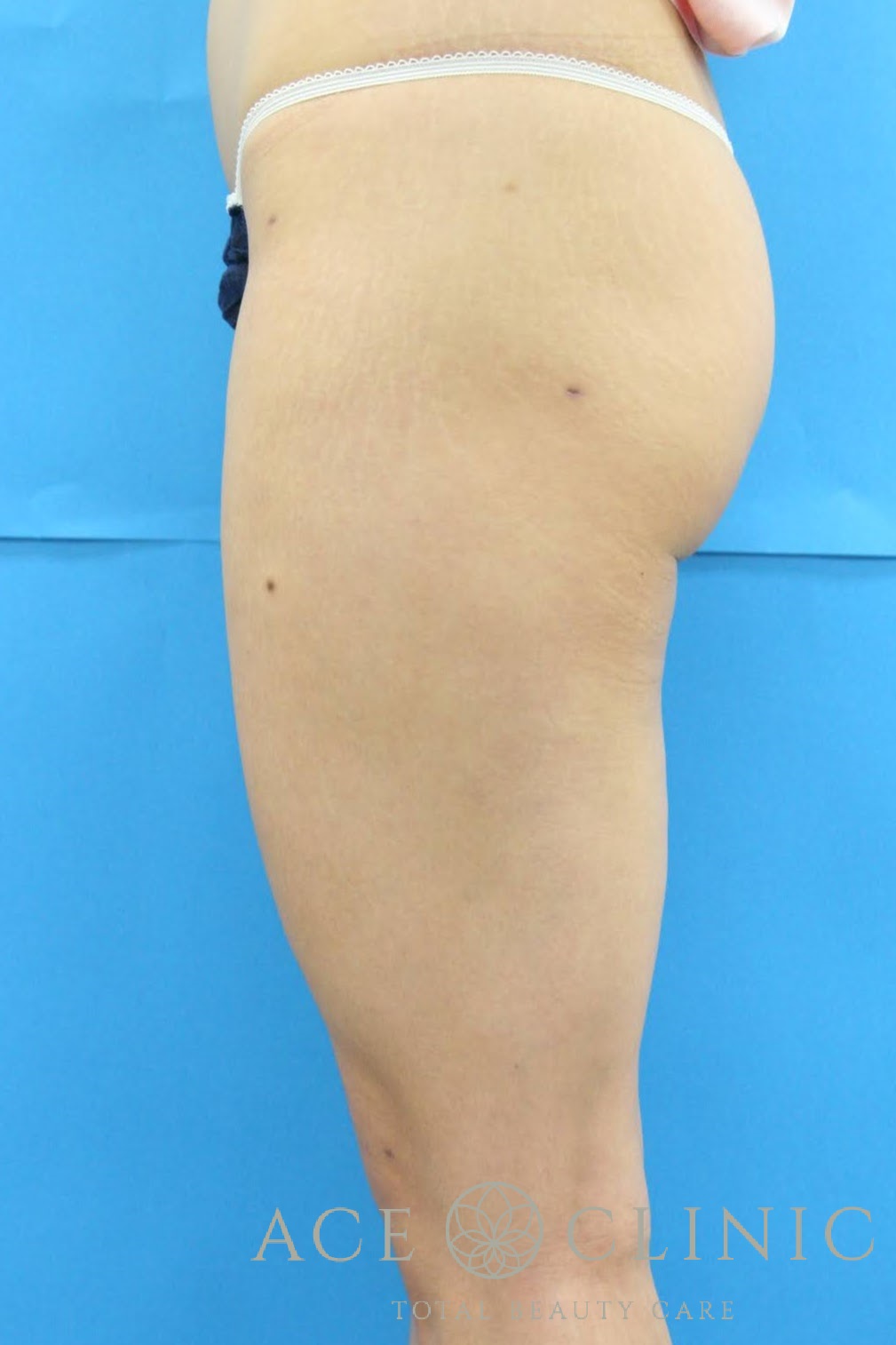 大腿脂肪吸引　左横　術後