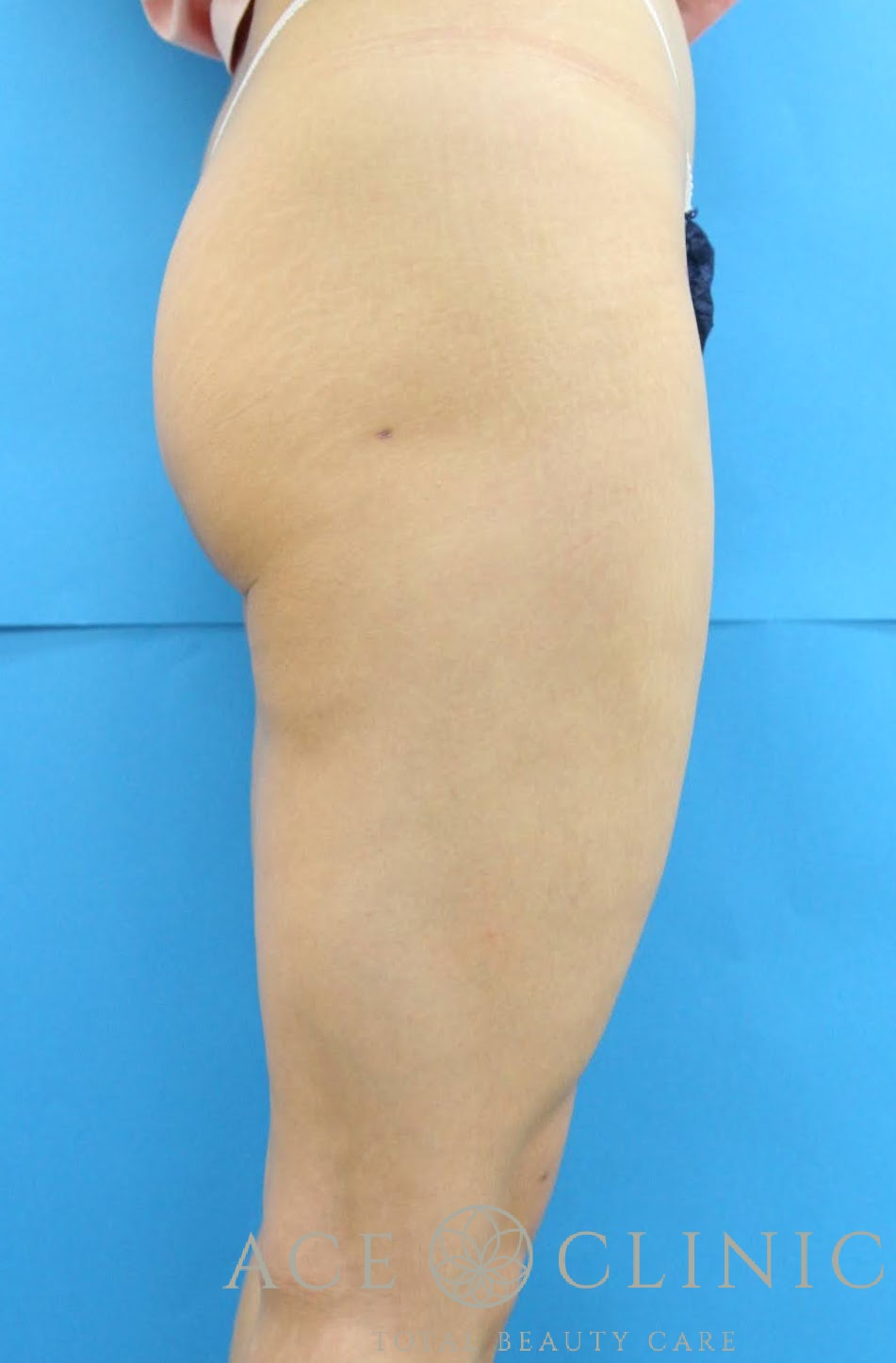 大腿脂肪吸引　右横　術後