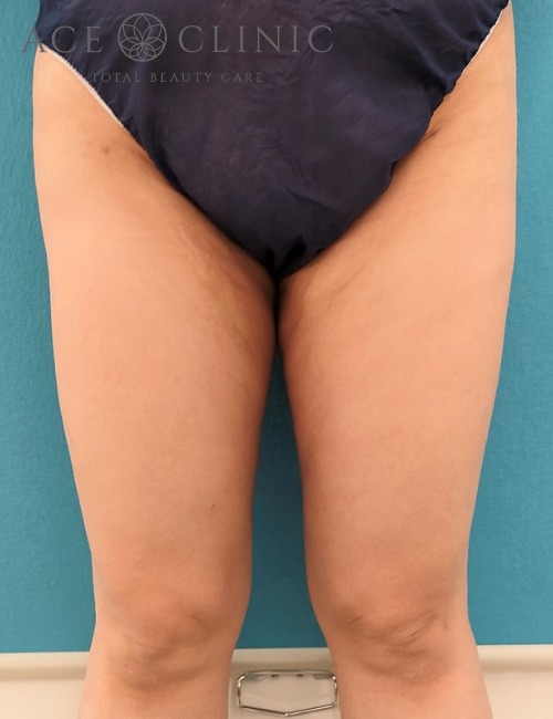 痩身治療‗大腿脂肪吸引症例_【エースクリニック】名古屋院・大阪梅田院 (4)