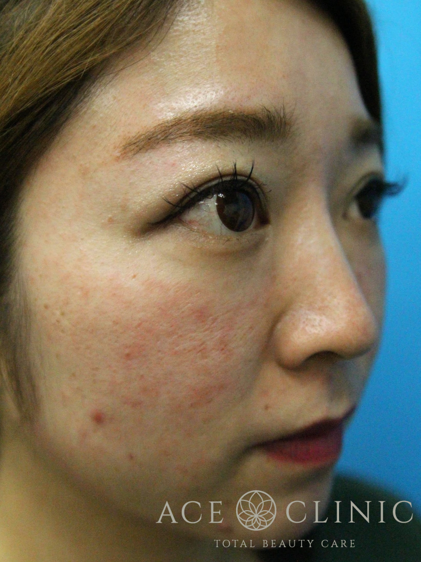 赤ら顔治療（Vビーム2）症例　30代女性　治療前　右斜め