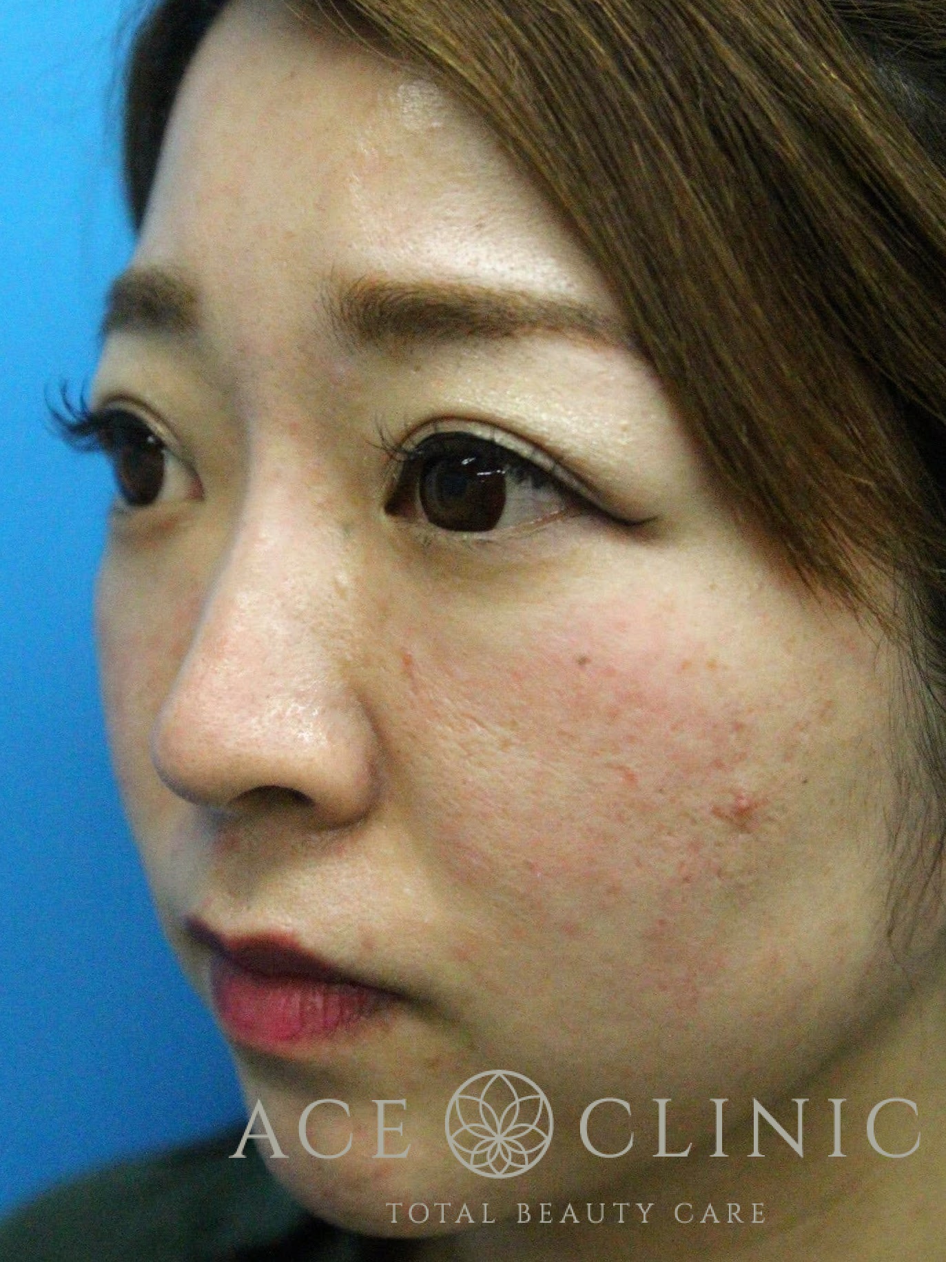 赤ら顔治療（Vビーム2）症例　30代女性　治療前　左斜め