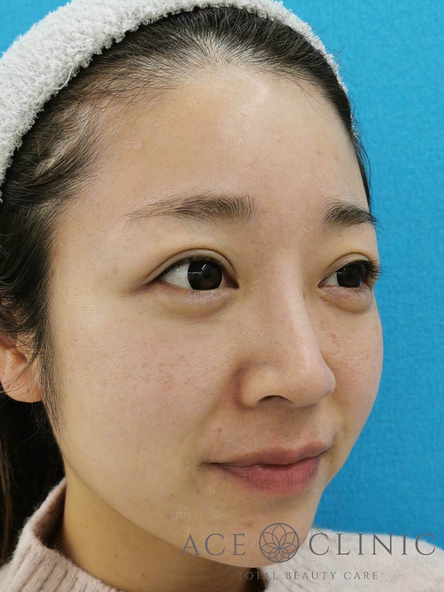 赤ら顔治療（Vビーム2）症例　30代女性　5回照射後　右斜め