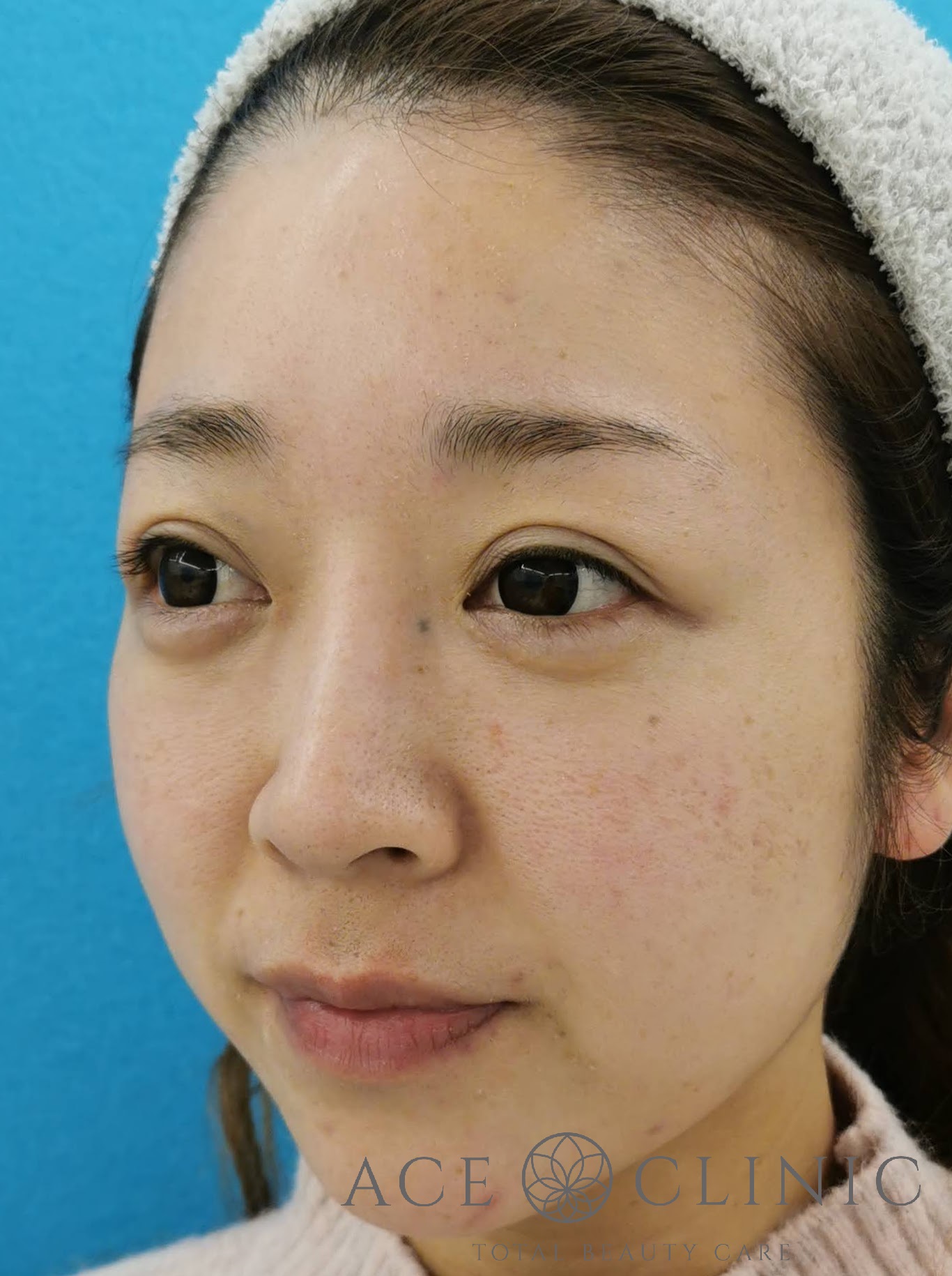 赤ら顔治療（Vビーム2）症例　30代女性　5回照射後　左斜め