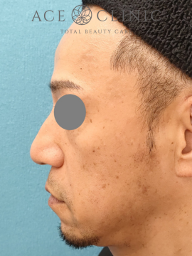 鼻尖縮小術　症例6　術後　横