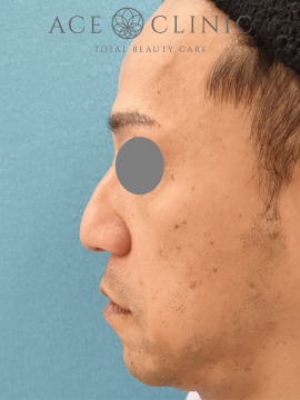 鼻尖縮小術　症例6　術前　横