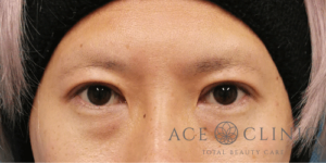 眼瞼下垂症例－中山医師
