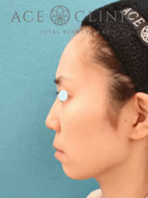 鼻複合手術鼻中隔延長+プロテーゼ
