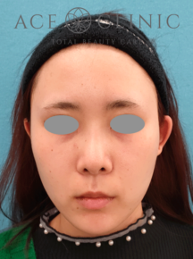 鼻中隔延長＋鼻プロテーゼ｜症例8｜27歳女性｜術後2M｜エースクリニック名古屋院