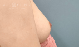 乳頭縮小症例-中山医師