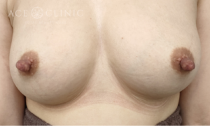 乳頭縮小症例-中山医師