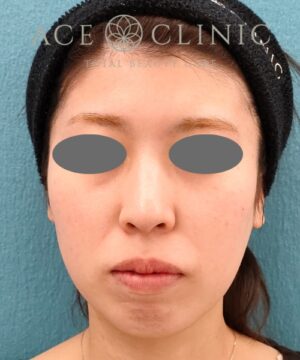 リポットレーザー|症例2 |20代女性|術後|エースクリニック名古屋院