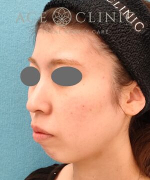 リポットレーザー|症例2 |20代女性|術後|エースクリニック名古屋院