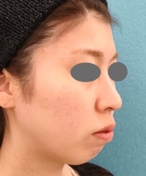 リポットレーザー|症例2 |20代女性|術後|エースクリニック名古屋院