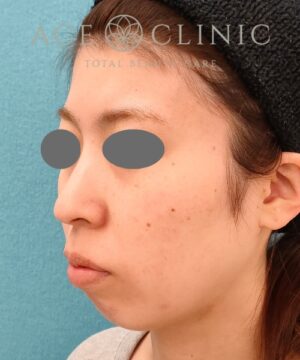 リポットレーザー|症例2 |20代女性|術前|エースクリニック名古屋院